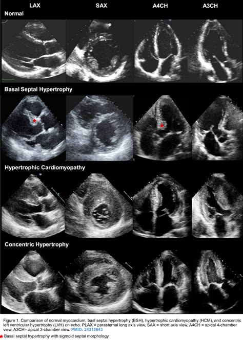 hypertrophy lv|Lv hypertrophy on echo.